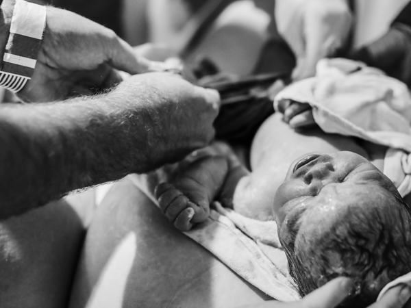 Aufnahme eines Neuborenen, bei dem gerade die Nabelschnur durchtrennt wird.