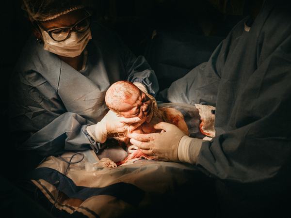 Aufnahme eines gerade frisch geborenen Babys bei einem Kaiserschnitt.
